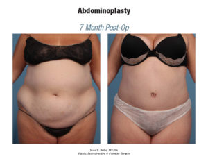 Is the Tummy Tuck Belt a Scam?