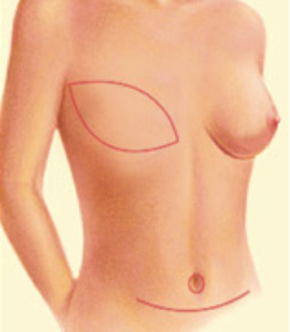 breast-reconstruction2
