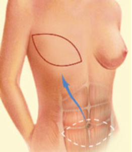 breast-reconstruction3