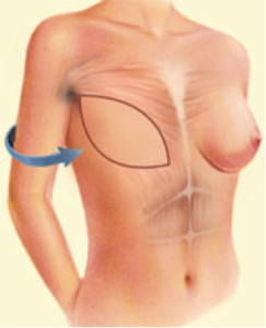 breast-reconstruction6