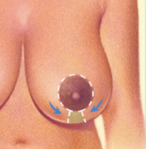 breast-reduc1