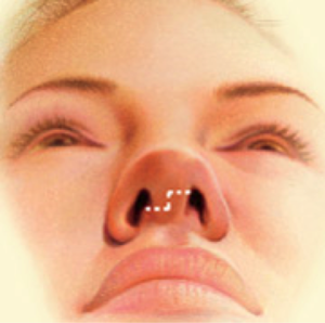 nose surgery3