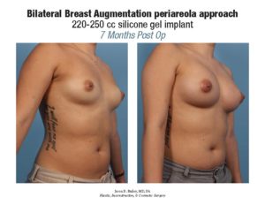 bilateral-breast-augmentation-periareola-approach1
